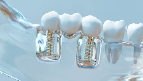 Titánrészecskék hozhatók összefüggésbe az antibiotikumok hatástalanságával periimplantitisz esetén